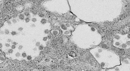 新冠病毒感染细胞超薄切片
